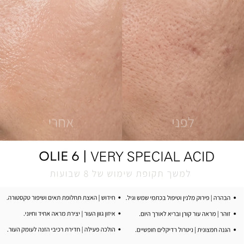 VERY SPECIAL ACID | סרום רב-תכליתי להבהרה וזוהר